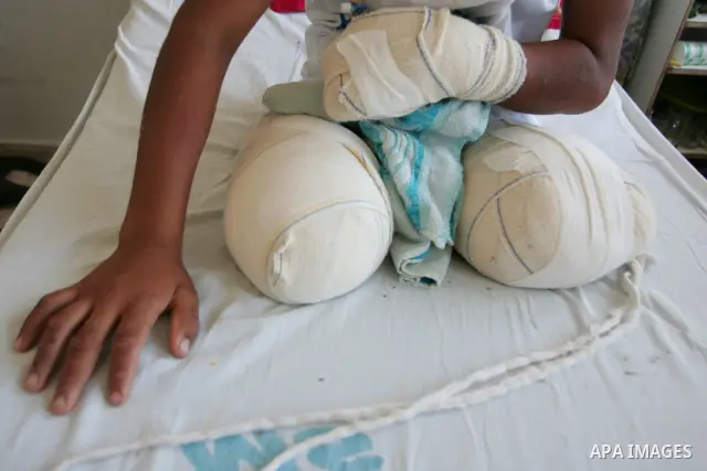 A Palestinian youth Mohammed Dahlez who lost his legs after Israeli mine explosion, sits in his bed at the European hospital in the south Gaza strip town of Khan Younis on June 14,2010. Photo by Hatem Omar