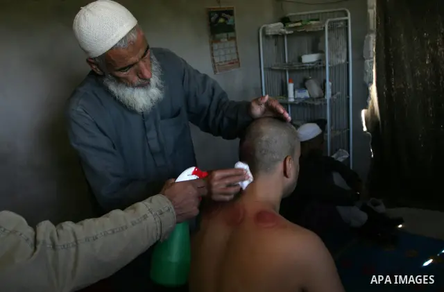 Palestinian therapist Rabhy Abu Jazar treats a patient suffering from backache and headaches using a form of cupping therapy which extracts blood from the patient, at his clinic in the Rafah refugee camp, southern Gaza S...