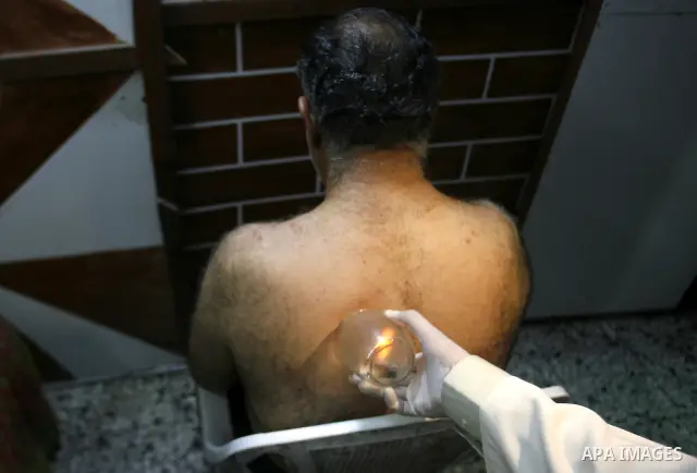 Anwar Sheikh-Eid, 42, performs Hijama or cupping therapy, to Palestinian patient Musa Sheikh El Eid at his shop in the southern Gaza Strip city of Rafah on 27 June 2012. Cupping is an ancient form of alternative medicine...
