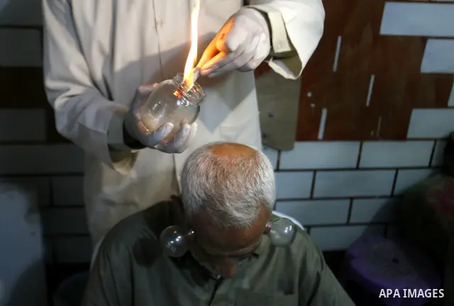 Anwar Sheikh-Eid, 42, performs Hijama or cupping therapy, to Palestinian patient Musa Sheikh El Eid at his shop in the southern Gaza Strip city of Rafah on 27 June 2012. Cupping is an ancient form of alternative medicine...