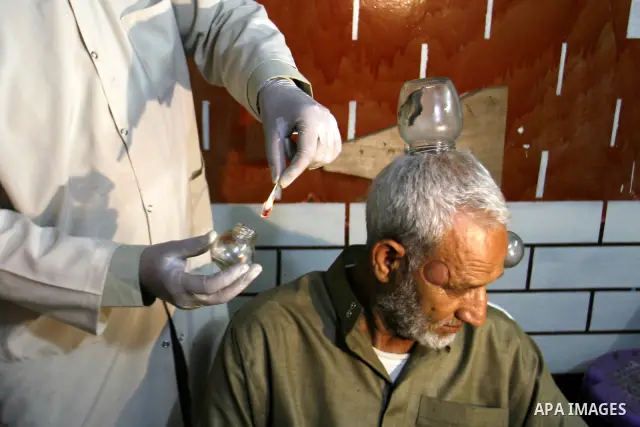 Anwar Sheikh-Eid, 42, performs Hijama or cupping therapy, to Palestinian patient Musa Sheikh El Eid at his shop in the southern Gaza Strip city of Rafah on 27 June 2012. Cupping is an ancient form of alternative medicine...