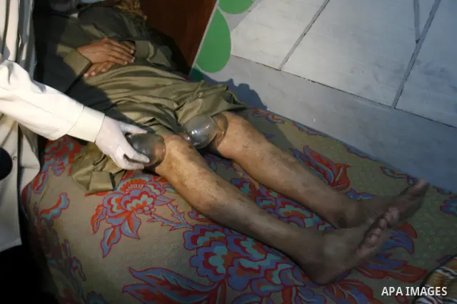 Anwar Sheikh-Eid, 42, performs Hijama or cupping therapy, to Palestinian patient Musa Sheikh El Eid at his shop in the southern Gaza Strip city of Rafah on 27 June 2012. Cupping is an ancient form of alternative medicine...