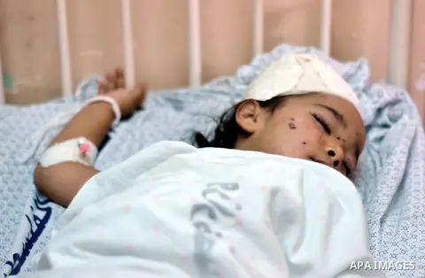 Palestinian Children rests at the Shifa hospital to receiving treatment, in Gaza City, on August 2, 2014. The Israeli army gave a first indication it was ending operations in parts of Gaza, while continuing to bombard ot...