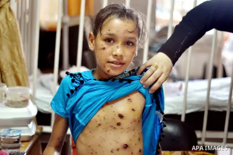 A Palestinian girl, who medics said was injured during the Israeli military offensive on Gaza Strip, shows her wounds at al-Shifa hospital in Gaza City on August 06, 2014. The ceasefire, which came into effect on August...