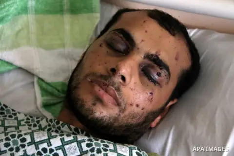 A Palestinian man, who medics said was wounded during the Israeli offensive, lies on a bed at the Red Crescent hospital, Cairo, Egypt on August 15, 2014. Two successive truces since Monday, expected to last through Augus...