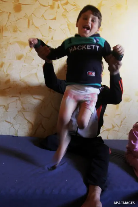 Palestinian Wael al-Namla and his son Sharif, who were both injured during the 50-day war between Israel and Hamas militants in the summer of 2014, play in on the bed at their house on Feb. 28, 2016 in Rafah in the south...