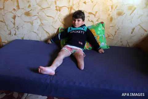 Palestinian child Sharif al-Namla who was injured during the 50-day war between Israel and Hamas militants in the summer of 2014, sits at his house on Feb. 28, 2016 in Rafah in the southern Gaza Strip. Wael al-Namla, 27,...