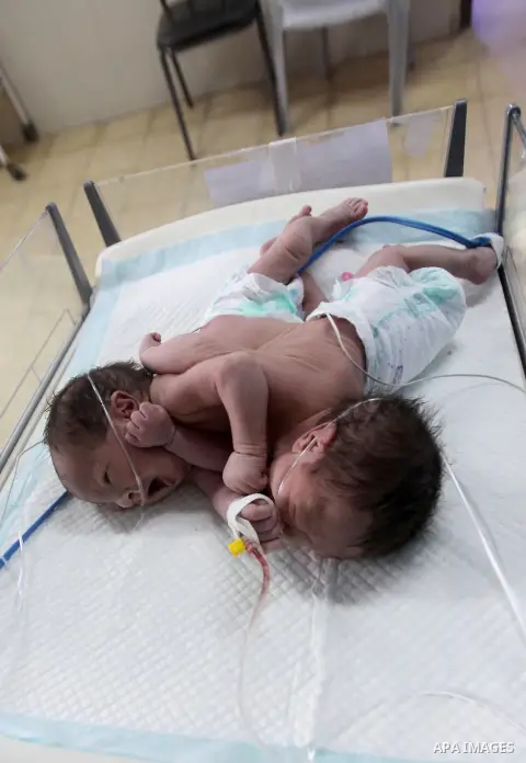 One-day-old Palestinian conjoined twin boys lie in an incubator at the nursery Hospital in the West Bank city of Hebron, March 16, 2017. Photo by Wisam Hashlamoun