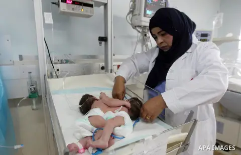 A Palestinian nurse checks on a One-day-old Palestinian conjoined twin boys lie in an incubator at the nursery Hospital in the West Bank city of Hebron, March 16, 2017. Photo by Wisam Hashlamoun