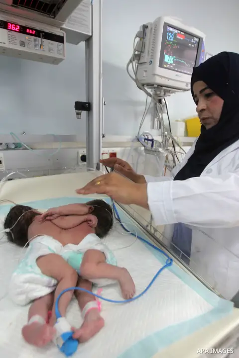 A Palestinian nurse checks on a One-day-old Palestinian conjoined twin boys lie in an incubator at the nursery Hospital in the West Bank city of Hebron, March 16, 2017. Photo by Wisam Hashlamoun
