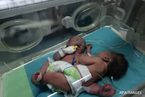One-day-old Palestinian conjoined twins boys (Siamese twin) from the Ghanem family with one body but two heads, lie in an incubator at the neonatal intensive care unit at Shifa hospital in Gaza city on October 22, 2017....