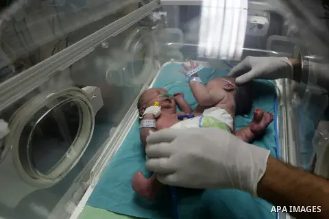 One-day-old Palestinian conjoined twins boys (Siamese twin) from the Ghanem family with one body but two heads, lie in an incubator at the neonatal intensive care unit at Shifa hospital in Gaza city on October 22, 2017....